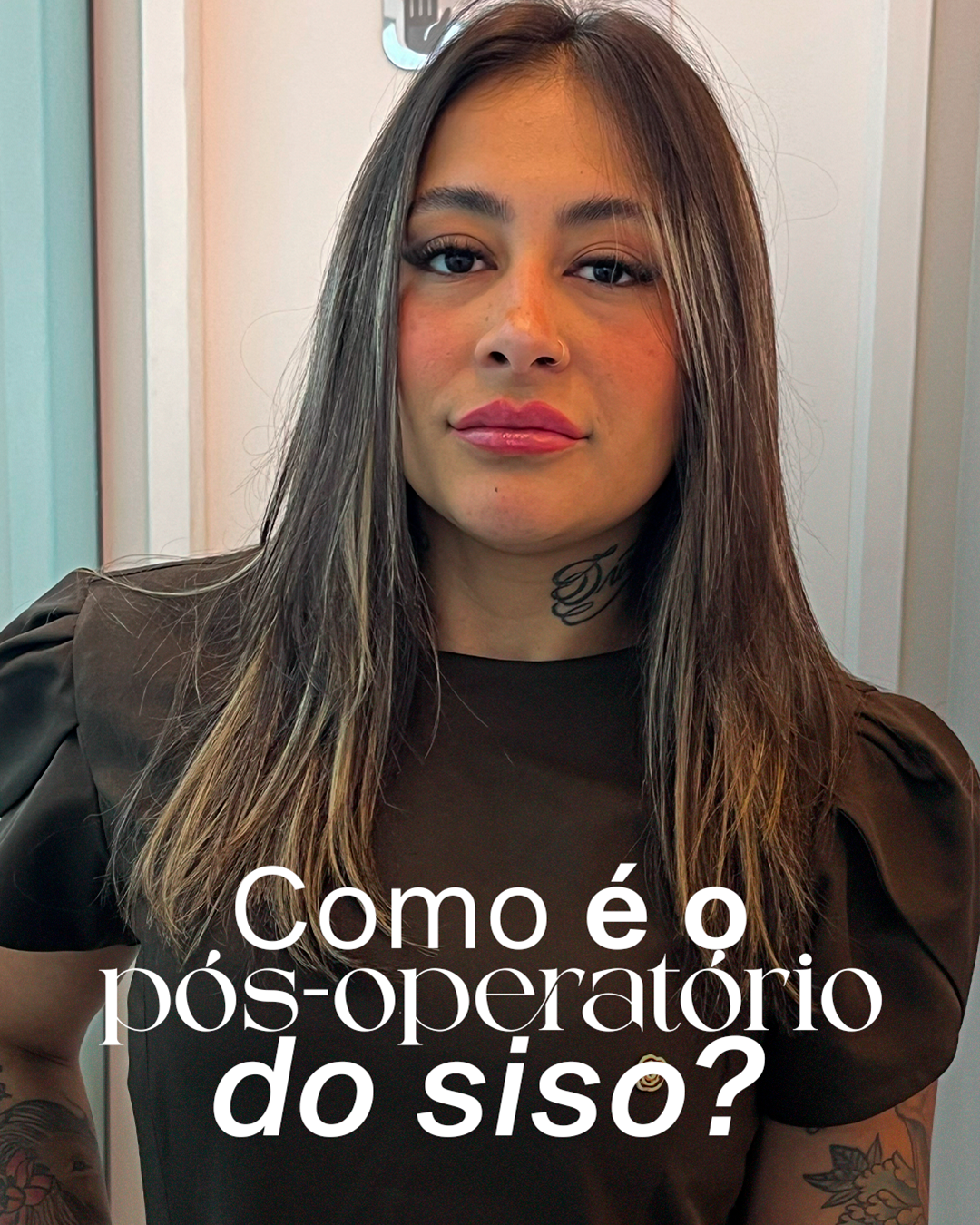 Como é o pós-operatório do siso