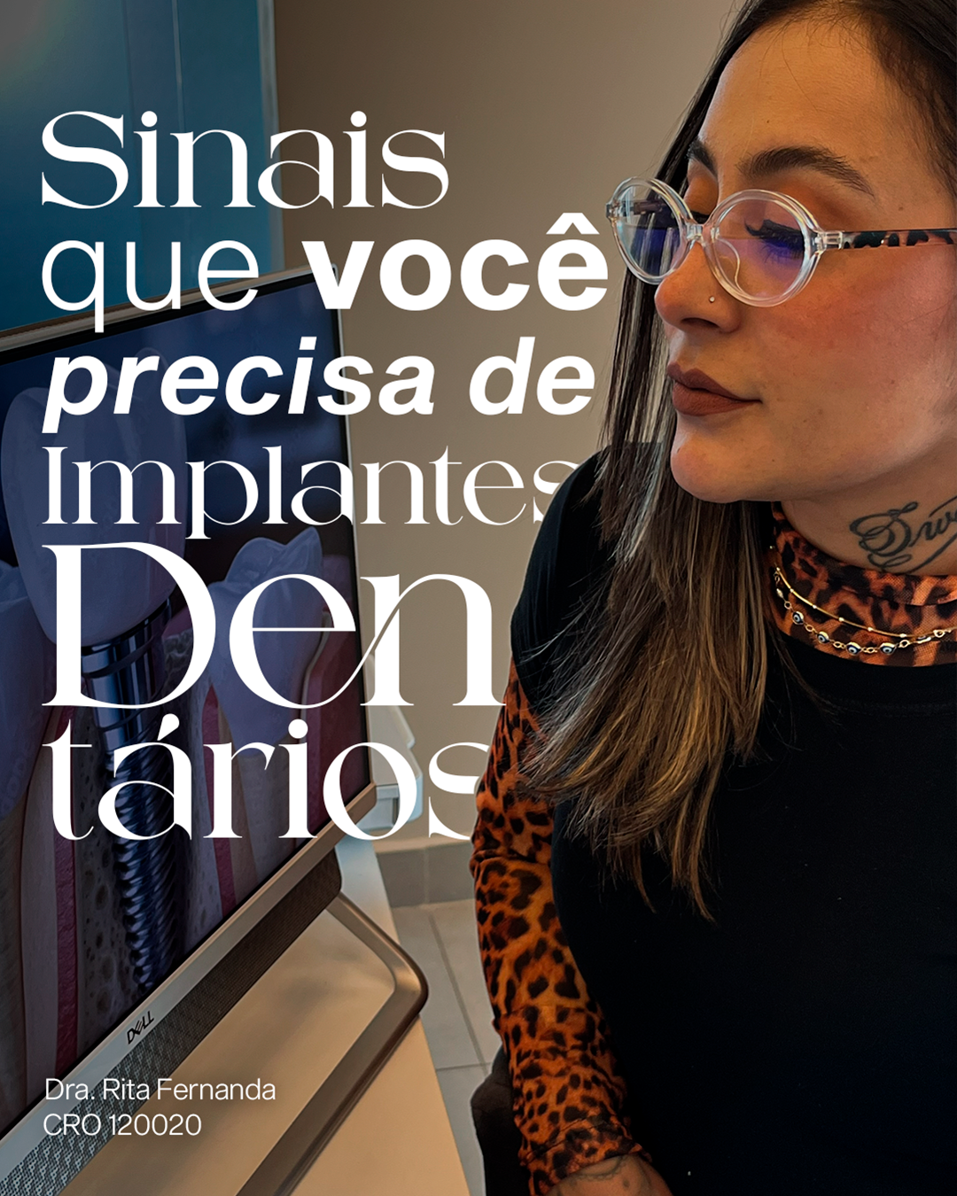 Sinais de que você precisa de implantes dentários