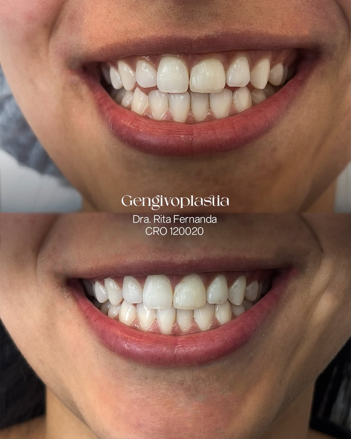 Resultado antes e depois de Gengivoplastia — Dra. Rita Fernanda