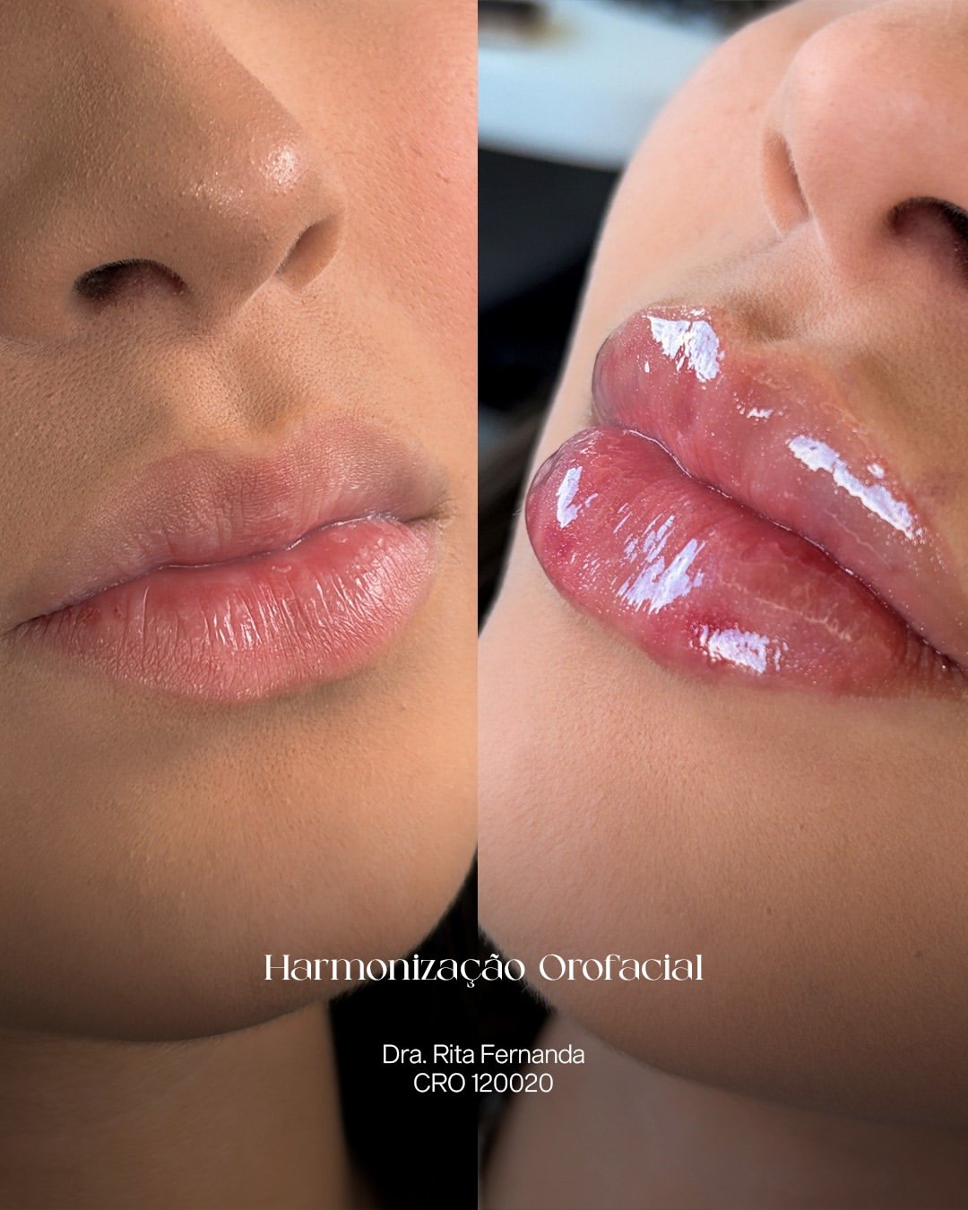 Resultado antes e depois de Harmonização Orofacial — Dra. Rita Fernanda