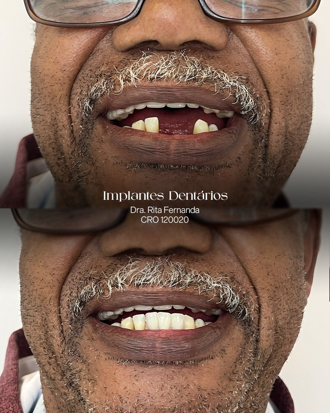 Resultado antes e depois de Implantes Dentários — Dra. Rita Fernanda